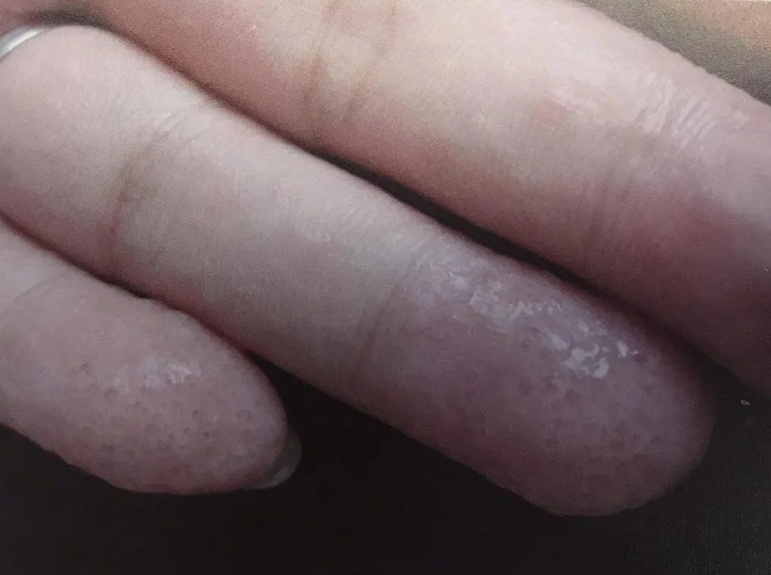 手上起小水疱、脱皮、还很痒，怎么回事？